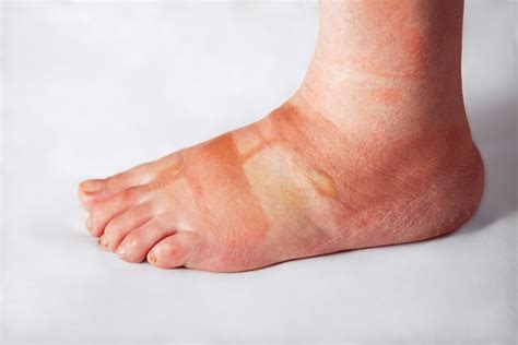 Edema